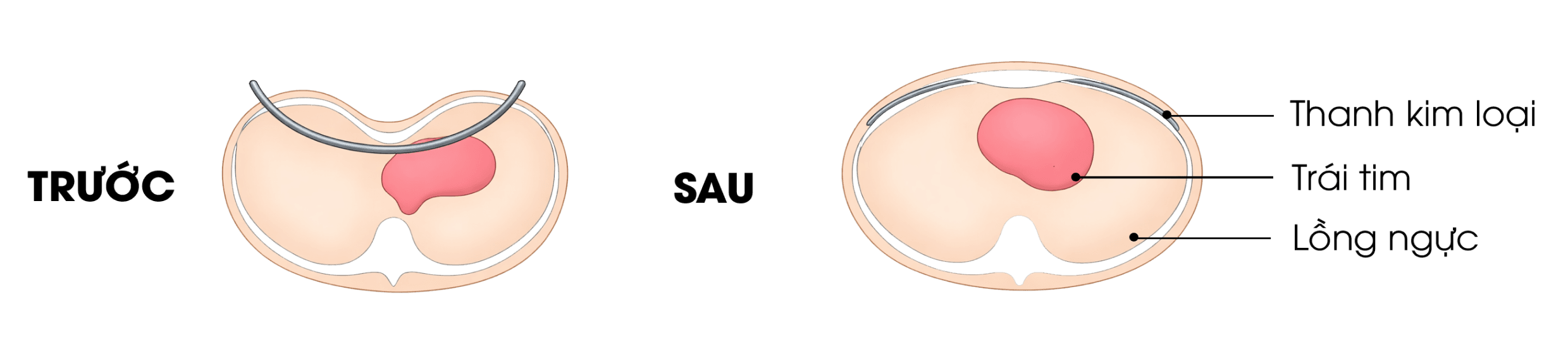 Minh họa trước và sau điều trị lõm ngực bằng phương pháp Nuss.
