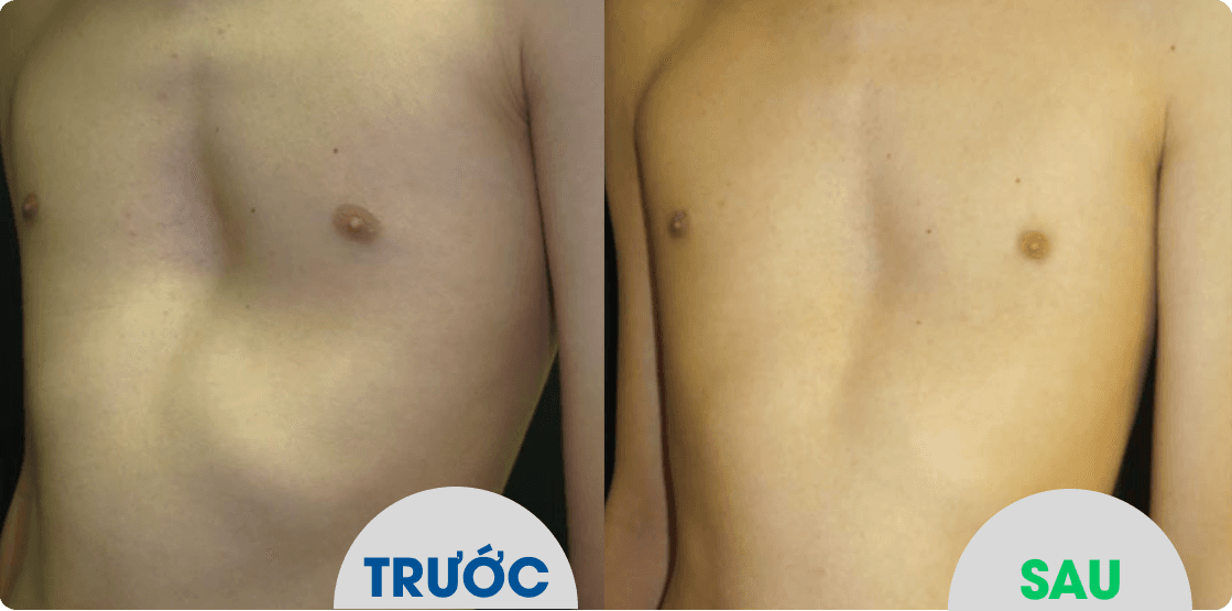 So sánh trước và sau điều trị lõm ngực trên bệnh nhân thứ hai.