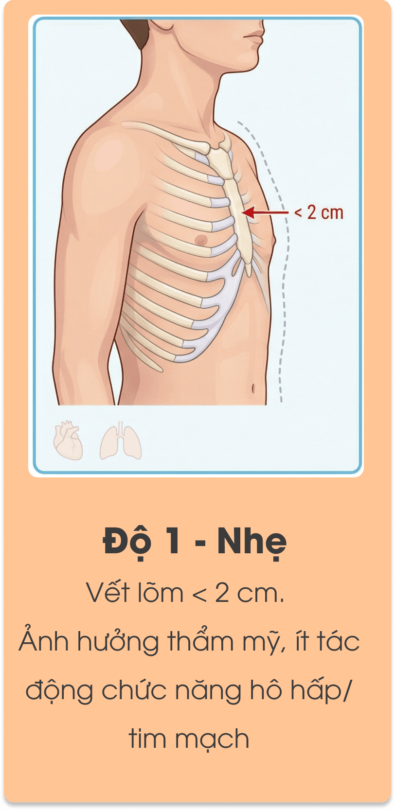 Minh họa mức độ lõm ngực độ 1.