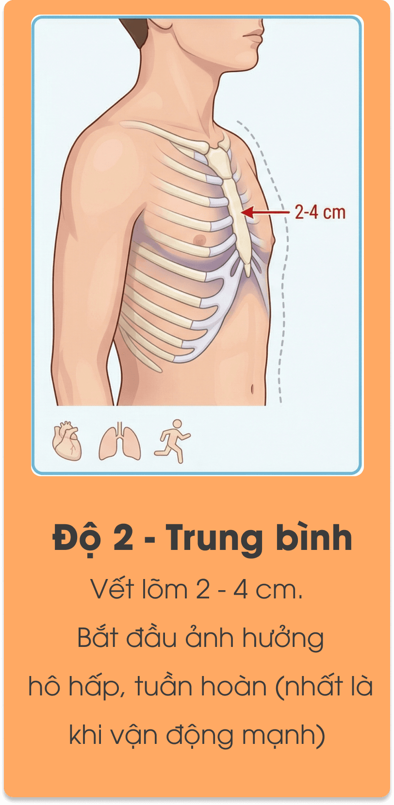 Minh họa mức độ lõm ngực độ 2.